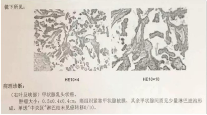 別慌，甲狀腺疾病還可以這樣投保！